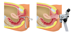 조직검사를 위한 생검 및 Colposcope