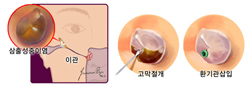 삼출성중이염의 치료