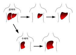 간이식