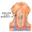 구강암4기A(림프절전이)