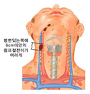 구강암4기A(림프절전이)