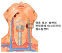 구강암4기A(림프절전이)