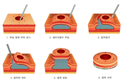 점막하절개박리술