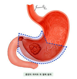 종양의 위치와 위 절제 범위