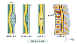 척추종양의 분류