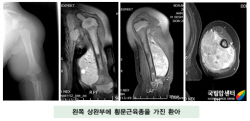 왼쪽 상완부에 횡문근육종을 가진 환아