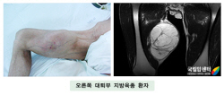 오른쪽 대퇴부 지방육종 환자