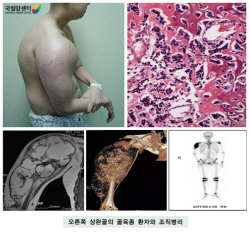 오른쪽 상완골의 골육종 환자와 조직병리사진