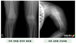 우측 대퇴골 원위부 골육종 & 좌측 상완골 유잉육종