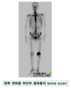 왼쪽 대퇴골 하단부 골육종의 bone scan