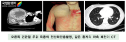 오른쪽 견관절 주위 육종의 전산화단층촬영, 같은 환자의 좌측 폐전이 CT