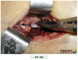 절개 생검