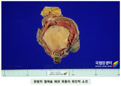광범위 절제술 해낸 육종의 육안적 소견