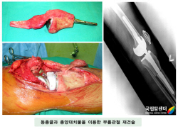 동종골과 종양대치물을 이용한 무릎관절 재건술