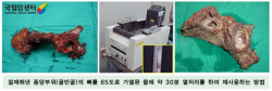 절제해낸 종양부위(골반골)의 뼈를 65도로 가열된 물에 약 30분 열처리를 하여 재사용하는 방법