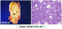 절제해낸 지방육종의 단면과 병리