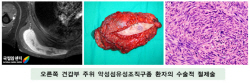 오른쪽 견갑부 주위 악성섬유성조직구종 환자의 수술적 절제술