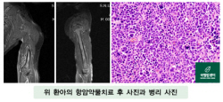 위 환아의 항암약물치료 후 사진과 병리 사진