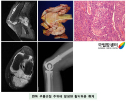 왼쪽 무릎관절 주위에 발생된 활막육종 환자