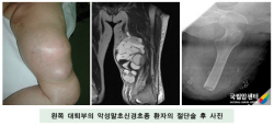 왼쪽 대퇴부의 악성말초신경초종 환자의 절단술후 사진
