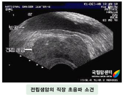 전립선암의 직장 초음파 소견