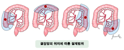 결장암의 위치에 따른 절제범위