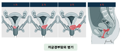 자궁경부암의 병기