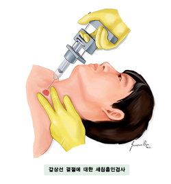 갑상선 결절에 대한 세침흡인검사