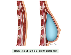 유방암 수술 후 보형물을 이용한 유방의 재건
