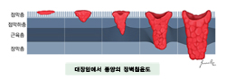 대장암에서 종양의 장벽침윤도