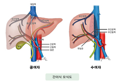 간이식 모식도