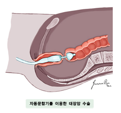 자동문합기를 이용한 대장암 수술