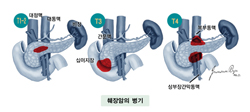 췌장암의 병기