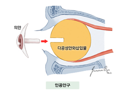 인공안구