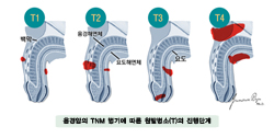 음경암의 TNM 병기에 따른 원발병소(T)의 진행단계