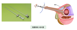 방광요도 내시경