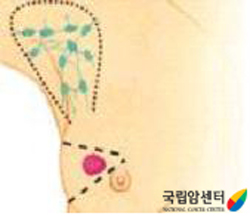 부분 절제술 모식도