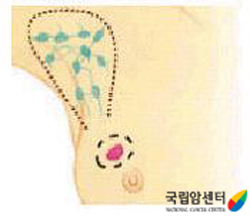 종괴절제술 모식도