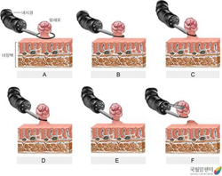 내시경적 절제술, 내시경, 절제술, 직장암