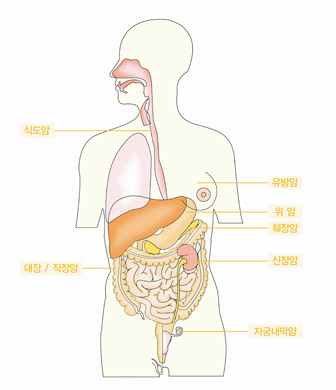 비만과 관련된 질환