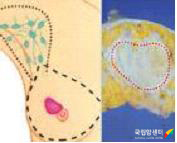변형근치절제술 모식도