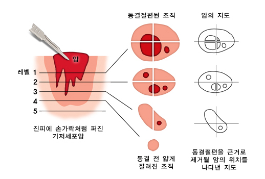 모즈 수술