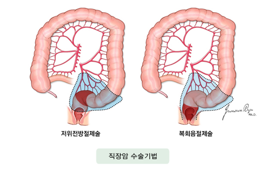 직장암 수술기법
