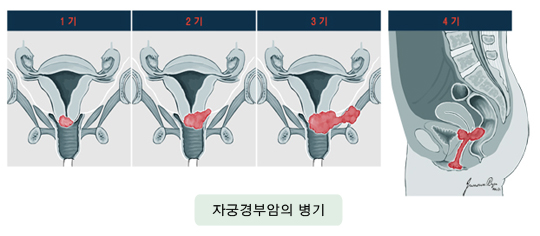 자궁경부암의 병기
