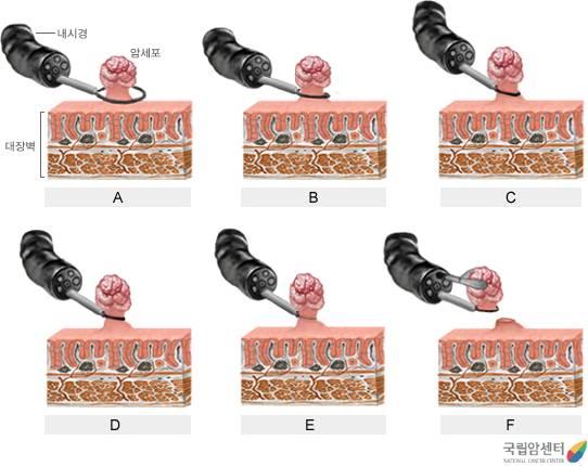 직장암의 내시경적 절제술
