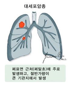대세포암종