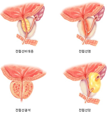전립선 이상의 예