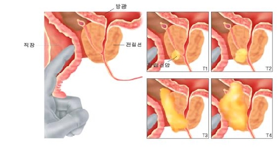 전립선암의 병기
