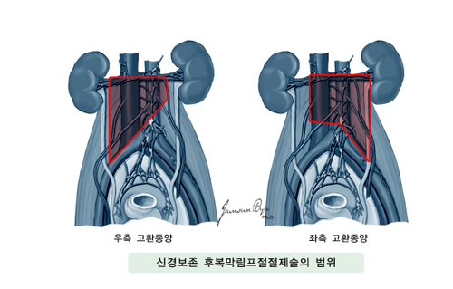신경보존 후복막림프절 절제술의 범위