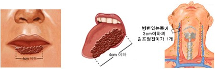 구강암 3기